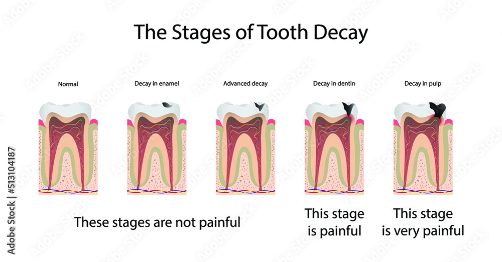 illustration of biology and medical, The stages of tooth decay, Tooth