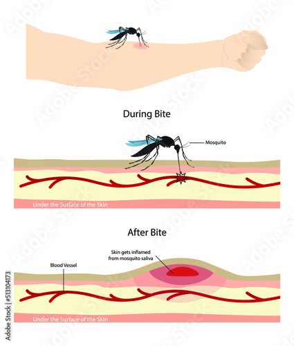 illustration of biology and animals, mosquito sucking blood on human body, Mosquito cartoon sucking blood from human skin, mosquito transmits dengue viruses to humans through bites photo