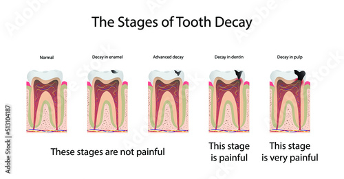 illustration of biology and medical, The stages of tooth decay, Tooth decay is damage that occurs to teeth, Dental plaque is important to the tooth decay process