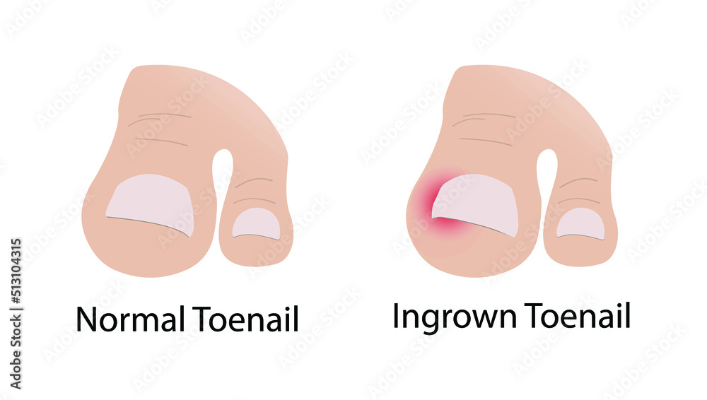 illustration of biology and medical, Normal Toenail and Ingrown Toenail, Ingrown toenails occur
