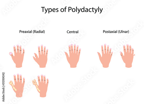 Fototapeta Naklejka Na Ścianę i Meble -  illustration of biology and medical, Types of polydactyly, Symptoms of Polydactyly, polydactyly is an anomaly in humans and animals resulting in supernumerary fingers or toes