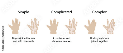 illustration of biology and medical, Types of hand syndactyly, depending on the size and the participation or not of bony structures, Webbed Fingers