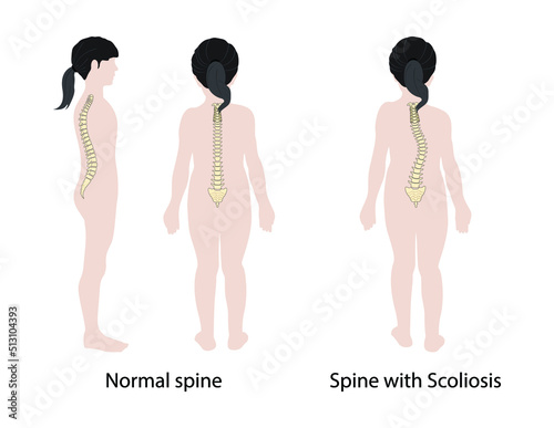illustration of biology and medical, Scoliosis is a medical condition in which a person's spine has a sideways curve, Sideways curve in the back