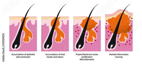 illustration of biology and medical, Clogged pores are a common skin concern that may lead to acne, Skin problems, acne, pimples and clogged pores, swelling, pain and irritation deep in the skin