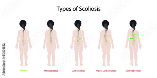 illustration of biology and medical, Types of Scoliosis, the spine twists and curves to the side,  spine has a sideways curve, Sideways curve in the back