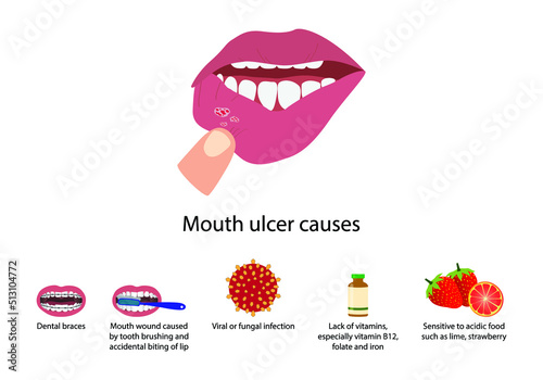 illustration of biology and medical, Aphthous ulcer, Mouth ulcer causes, Aphthous stomatitis, An ulcer in the mouth, caused by a break in the mucous membrane photo