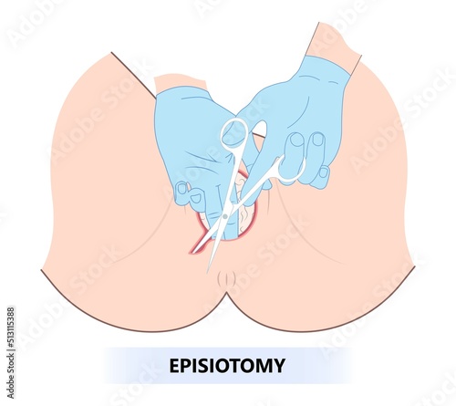 C-section of the vagina with perineal tear obstetrician give birth labor baby medio lateral anal woman