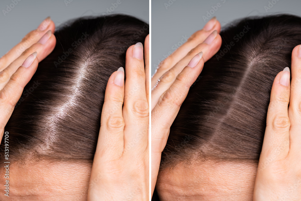 Fototapeta premium Woman Before And After Hair Loss