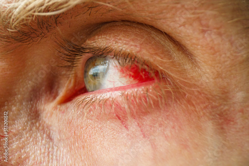 Subconjunctival hemorrhage - hyposphagma. Closeup of red bloodshot eye. Eye with burst blood vessels close up