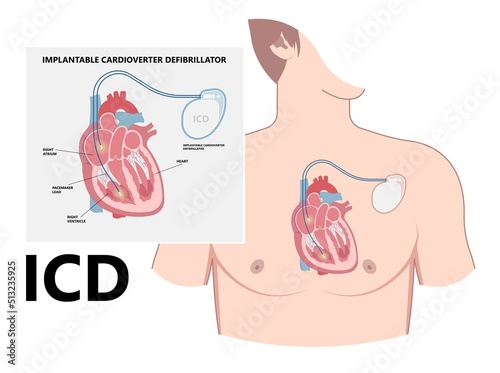 Pacemaker ICD Implantable Cardioverte Defibrillator Pulse Generator Stimulate of Heart Prevent Bradycardia Electronic Medical Device photo