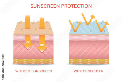 Protection of the skin from ultraviolet radiation. Damaged human skin exfoliates before and after sun protection, the fatty layers of the body, the epidermis. Vector illustration