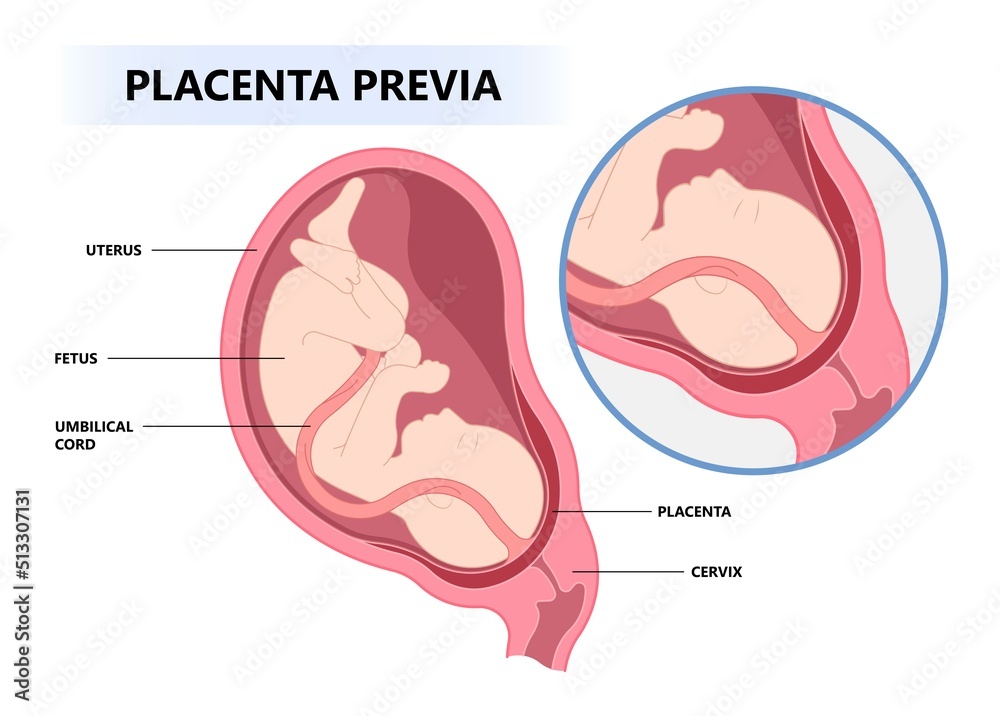 cervix contraction the uterus vasa previa fetal infant baby born c