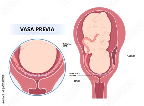 labor and c section fetal infant baby born vasa previa nuchal cord twins fetus defect vessels funic growth low lying birth fluid of PROM test increta cervix Bilobed sac uterus neck knotted contraction