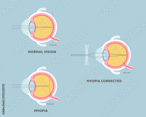 eyeball anatomy, internal organs body part nervous system, myopia concept, vector illustration cartoon flat design clip art