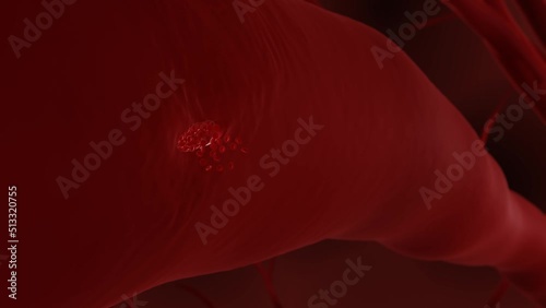 Hemorrhage also known as Internal Bleeding can lead to hemorrhagic stroke photo
