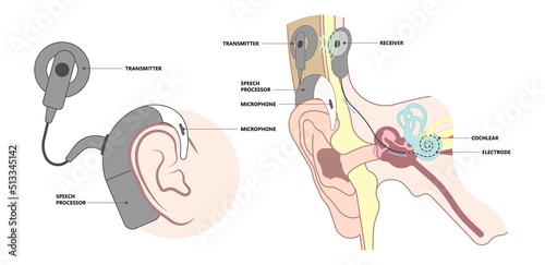 hearing aid ear child deaf signal baby inner middle bone loss outer canal birth meniere's cochlea brain implantation test exam photo
