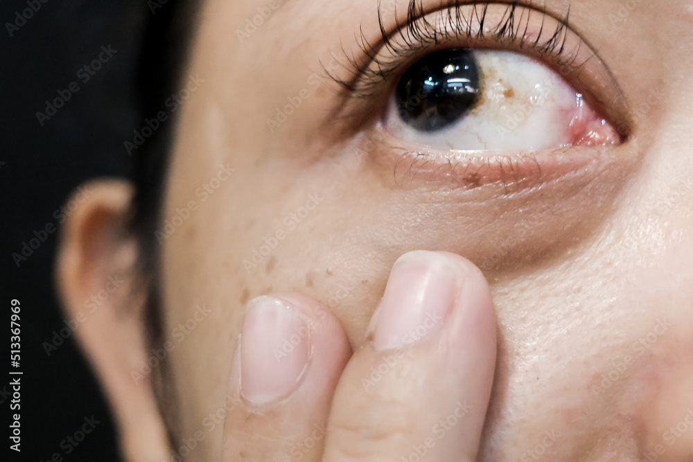 Fototapeta premium A Woman with Brown Spot on her Sclera Diagnosed as Hemorrhagic Conjunctivitis