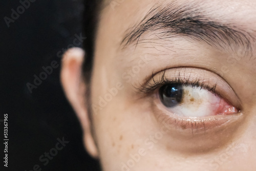 A Woman with Brown Spot on her Sclera Diagnosed as Hemorrhagic Conjunctivitis photo