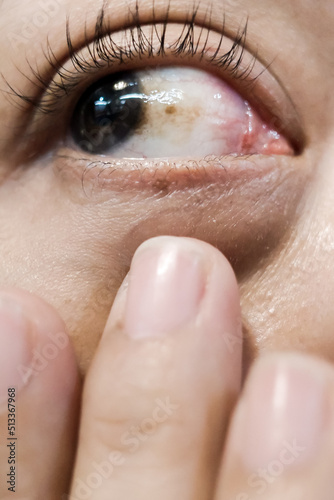 A Woman with Brown Spot on her Sclera Diagnosed as Hemorrhagic Conjunctivitis photo