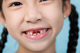 Closeup child girl smiling with loose teeth, Dentistry and Health care concept