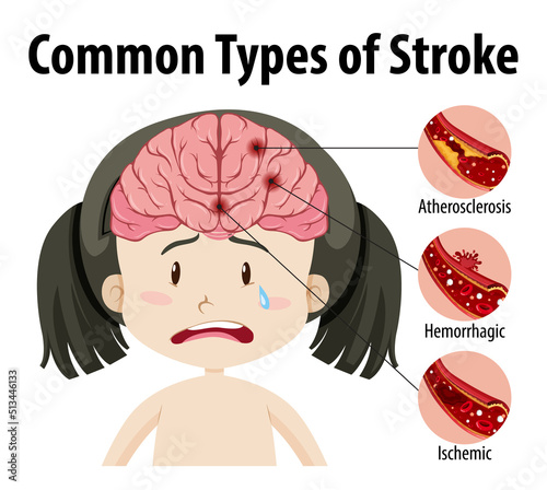 Human with common types of stroke