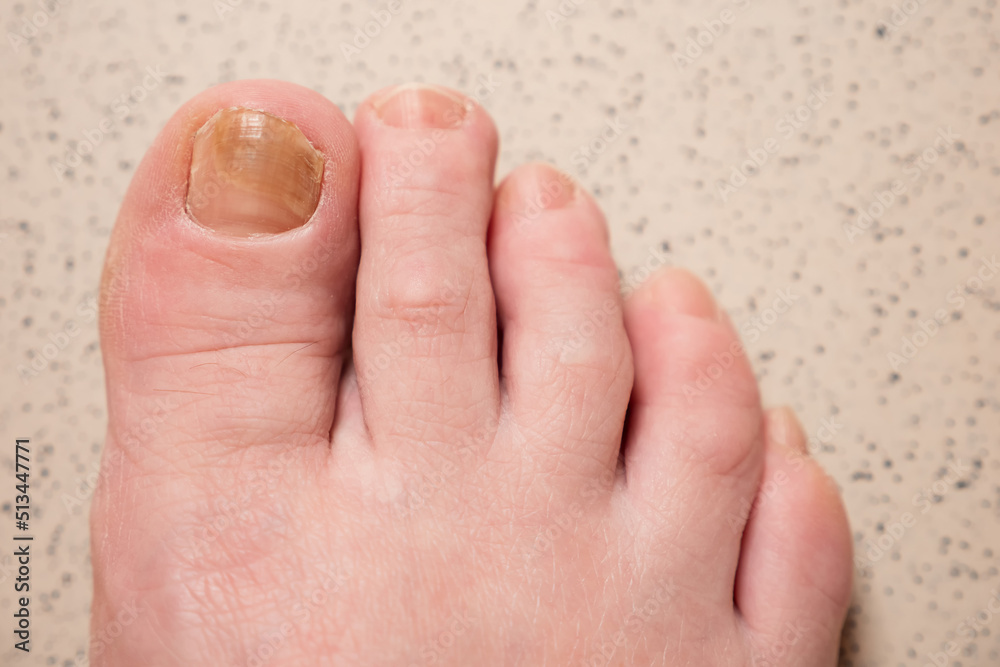 Toenails of woman with fungal infection. Brown bruise under nail of big