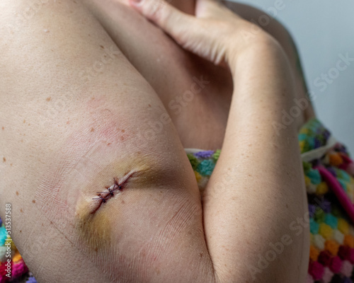 fresh suture stitches and bruise on a woman's healing arm wound following surgical removal of an atypical cancerous melanoma mole