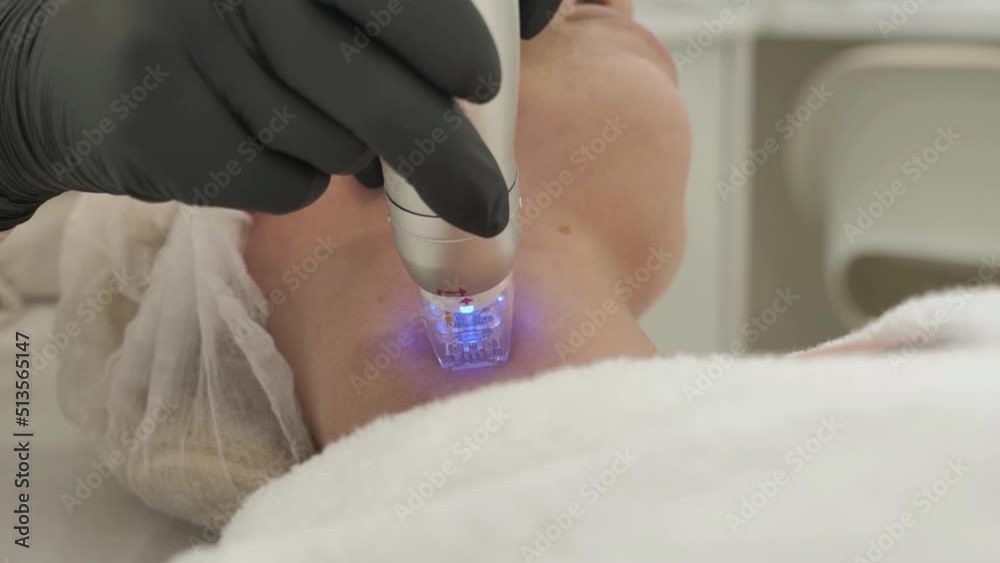 Procedure of Micro-Needle RF Lifting Neck Skin Close Up