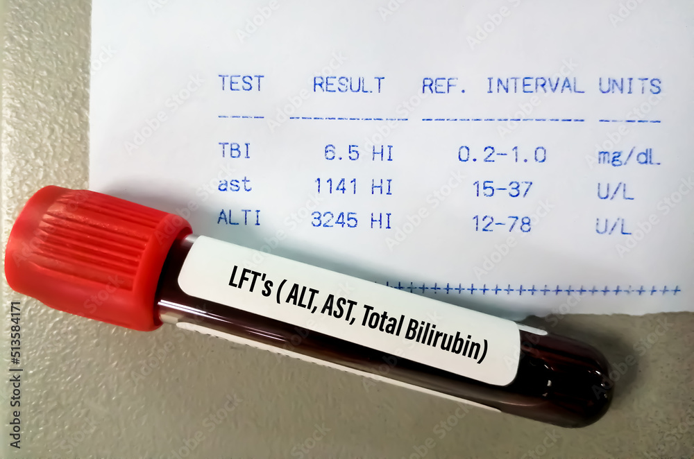 Blood sample isolated for Liver function test (LFTs) including ALT, AST