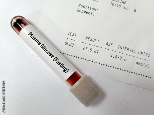 Sample tube of Plasma glucose Fasting test with abnormal report called hyperglycemia. photo