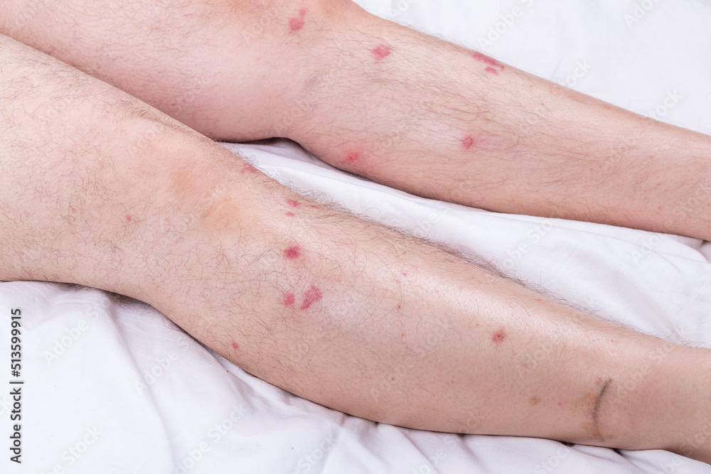 male legs with hair are lying on a white sheet. there are many small redness male legs with hair are lying on a white sheet. there are many small redness