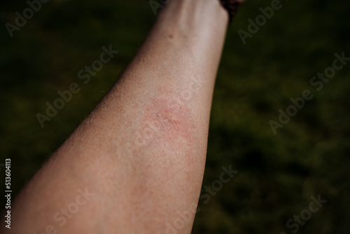 A blister mark from a midge bite on the human body, a red spot from a mosquito bite, reddening of the skin, itching on the body.