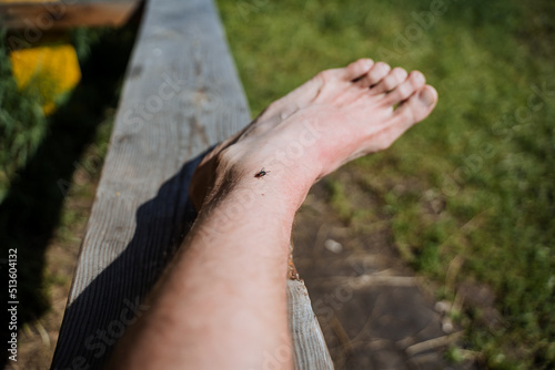 The insect bites the human leg, the blind man sits on the skin, the bite of a harmful reptile, the fly crawls on the leg, part of the body, toes.