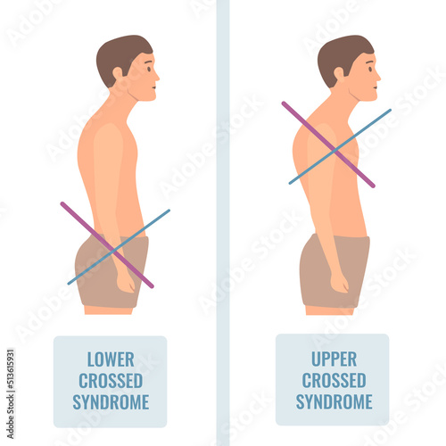 Upper and lower crossed syndrome medical diagram. Crooked man with muscle strength imbalance. Weak and overactive muscles therapy. Incorrect spine curvature caused by bad posture. Vector illustration.