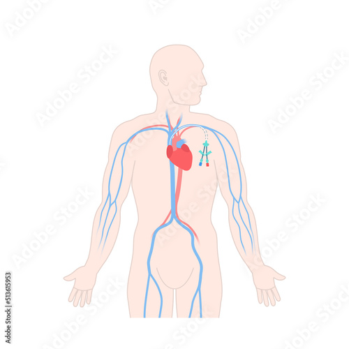 Tunneled central venous catheter placed in the subclavian vein. Man with CVC long term access device for chemotherapy infusions and blood sampling. Central line tube. Medical vector illustration.