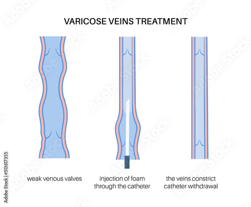 Varicose Injection procedure