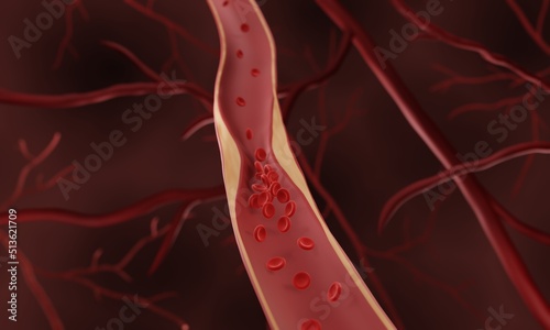 Atherosclerosis, Cholesterol and fat accumulating in arteries (plaque) leading to occlusion (blockage of blood vessel) photo