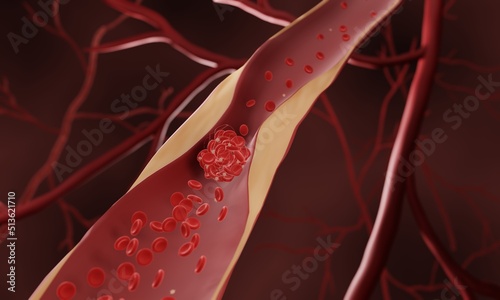 Blood clot, Blocked blood vessel in artherosclerosis (occlusion)