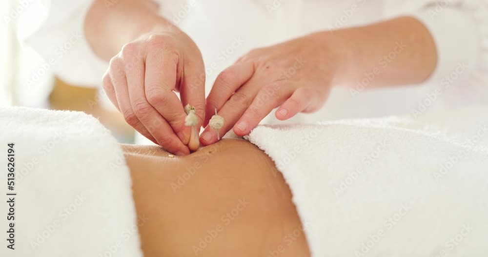 A therapist inserts acupuncture needles into the clients back. Alternative therapy to reduce stress and tension. Closeup of an acupuncturists hands treating a female patient in a wellness resort A therapist inserts acupuncture needles into the clients back. Alternative therapy to reduce stress and tension. Closeup of an acupuncturists hands treating a female patient in a wellness resort