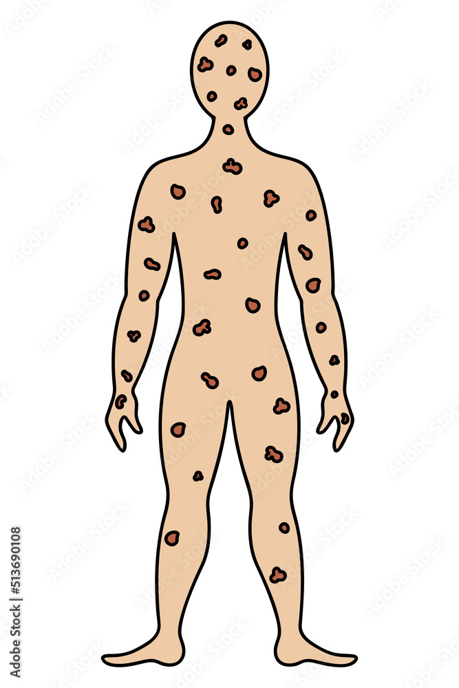 Smallpox Man Smallpox on the human body. Color vector illustration. The face and ...