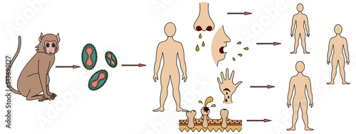 Monkeypox. Scheme of infection and methods of transmission to humans of the smallpox virus. Monkey - virus - man. Color vector illustration. Viral disease. Isolated background. Cartoon style. Medical 