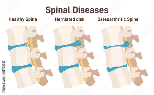 Spine vertebrae anatomy scheme. Healthy lumbar and back pain causes