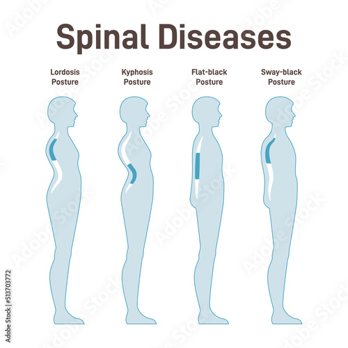 Diseases of the spine. Lordosis, kyphosis, flat-back and sway-back