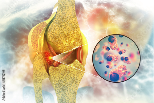 Bone cancer, knee joint, giant cell tumor of bone, osteosarcoma, 3d illustration photo