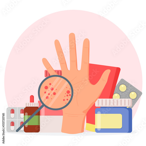 Large hand with red skin and rash. Psoriasis, vitiligo, dermatitis. Eczema is an inflammatory skin disease.