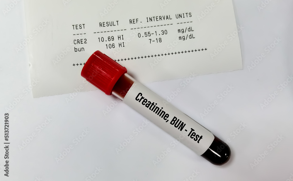 Blood sample tube isolated for Creatinine and BUN with abnormal report
