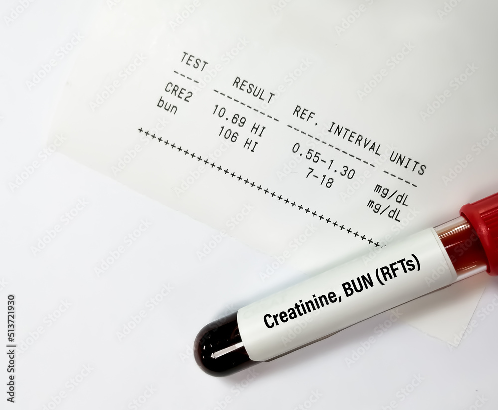 Obraz premium Blood sample tube isolated for Creatinine and BUN with abnormal report for the diagnosis of Kidney Function test.