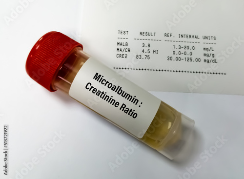 Urine Sample for Urine ACR or microalbumin creatinine Ratio. Chronic kidney disease (CKD). photo