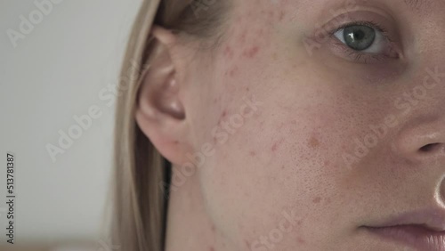 Woman with post acne scars. Skin health. 