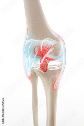 Medically accurate representation of an arthritic knee joint, knee meniscus, human leg